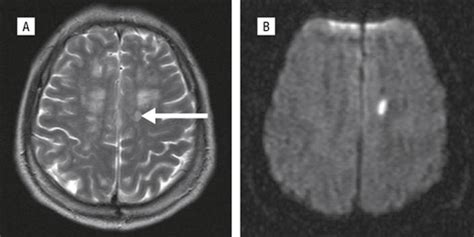 Ipsilateral Hemiparesis Caused By A Corona Radiata Infarct After A