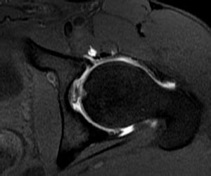 Labral Tears Of The Hip And Femoroacetabular Impingement Orthopaedia