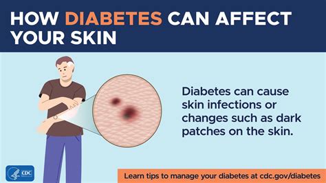 Diabetes And Your Skin Diabetes Cdc