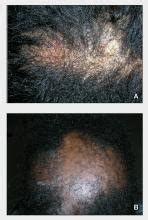 Central Centrifugal Cicatricial Alopecia | MDedge