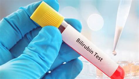 What are the symptoms of high bilirubin? - Titbitly