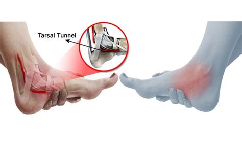 What Is Tarsal Tunnel Syndrome Symptoms And Treatment