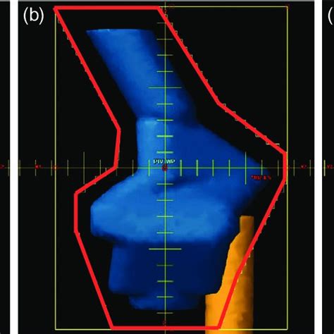 Dose Distributions Of The Dcrt Plan The Figure Shows The Composite