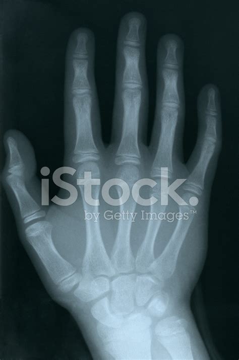 X-Ray Of A Human Hand Stock Photo | Royalty-Free | FreeImages