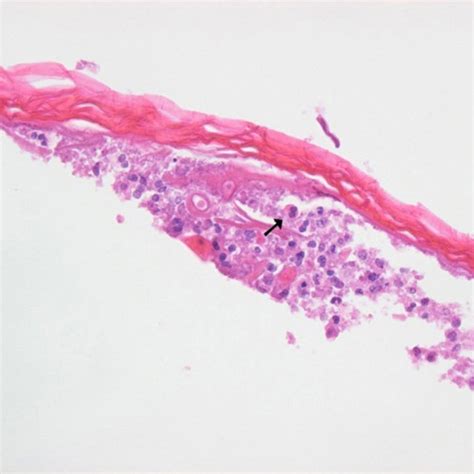 Generalized Pustules Arising On An Erythematous Background On The Trunk