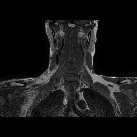 Brachial Plexus Injury Image Radiopaedia Org