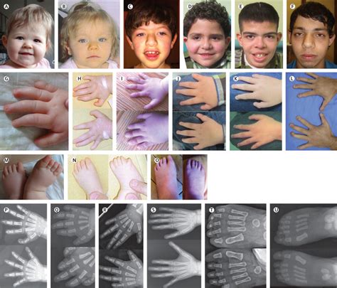 Physical Mutations In Humans