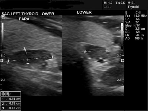 Parathyroid Adenoma Ultrasound