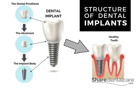 Dental Implants Advantages Procedure And Risks Share Dental Care