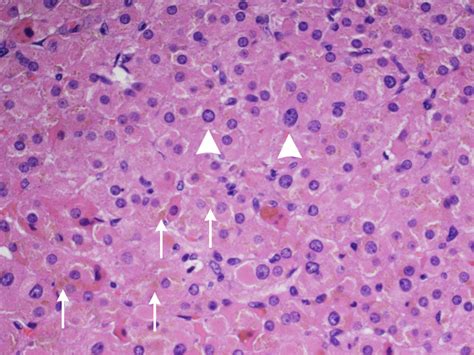 Histologically Cells With Eosinophilic Cytoplasm Arrow Heads