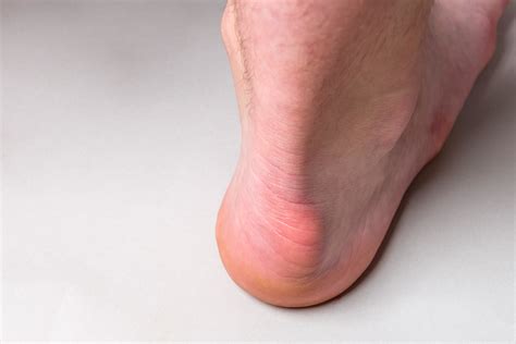 Haglunds Deformity Frisco Foot And Ankle Specialists