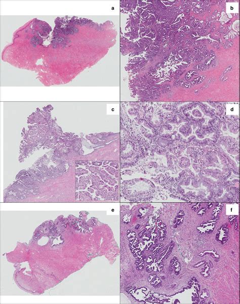 Pattern Based Classification Of Invasive Endocervical Adenocarcinoma