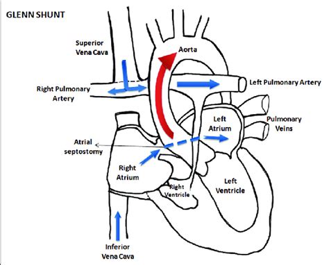 Diagrammatic representation of a Cavopulmonary Shunt | Download ...