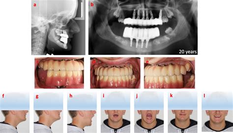 Radiographic And Photographic Overviews One Year Post Loading Of The