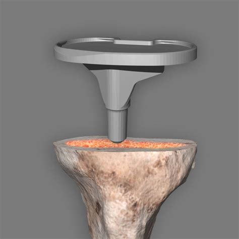 The artificial Knee Joint - ARTIQO Endoprothetik