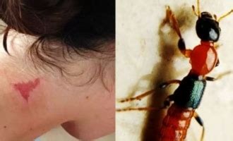 Nairobi Fly, causing skin rashes, enters India - Telugu News ...