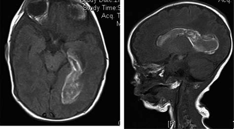 MRI of brain showing Intraventricular Hemorrhage | Download Scientific ...