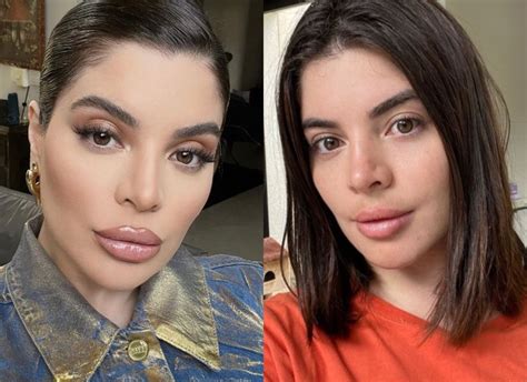 Gkay Desfaz Procedimento Labial Veja O Antes E Depois Not Cias Quem