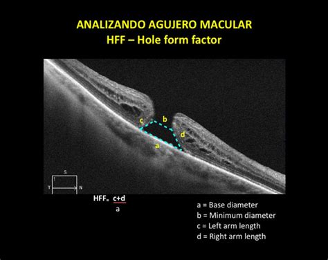 Agujero Macular Somos Retina Y M Cula Consultores