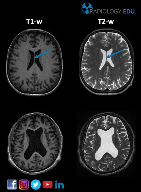 Septum Pellucidum Mri