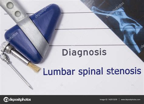 Neurological Diagnosis Of Lumbar Spinal Stenosis Neurologist Directory Hot Sex Picture