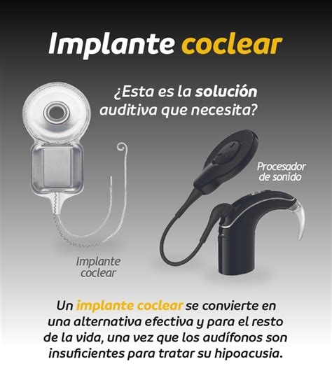 Diferencias Entre Implante Coclear E Implante Ac Stico