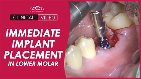 Immediate Implant Placement In Lower Molar [dr Kim Yongjin] Youtube