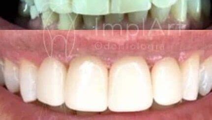 Lente Contato Dental Antes E Depois 44kb ImplArt