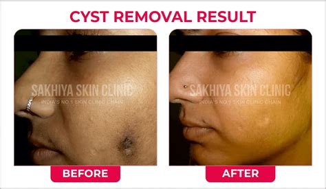 Cyst Removal Surgery Cyst Removal Surgery Treatment Sakhiya Skin Clinic