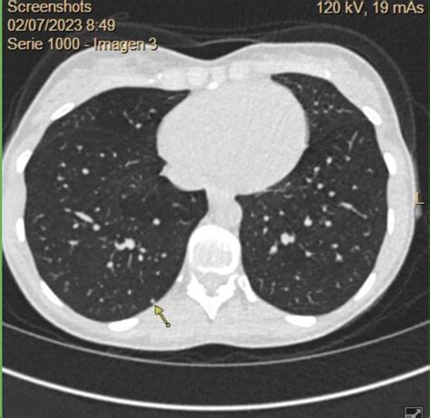 Lung Nodules on CT Scan? : r/AskDocs