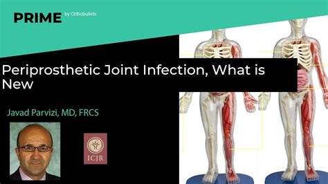 Periprosthetic Joint Infection What Is New Javad Parvizi Md Frcs