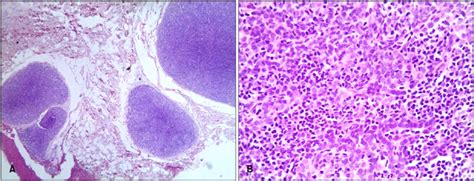 A Multiple Well Circumscribed Dermal Nodules Comprising Basophilic