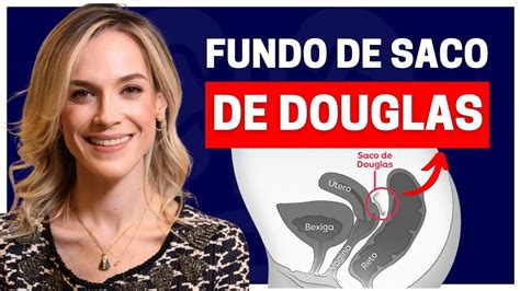 Fundo De Saco De Douglas Tudo Que Voc Precisa Saber Youtube