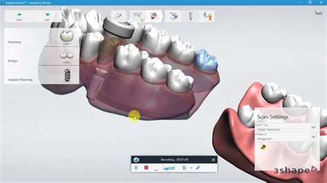 3shape Implant Studio™anatomy Design 2015 Trios Scan Import Youtube