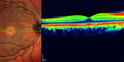 Heidelberg Spectralis 4d Oct Detecting Eye Disease Early