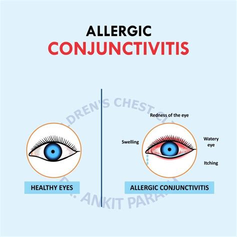 Allergic Conjunctivitis Eye Drops