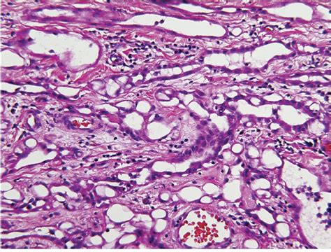 Lesional Cells Range From Plump Epithelioid Cells To Flattened Cells Download Scientific