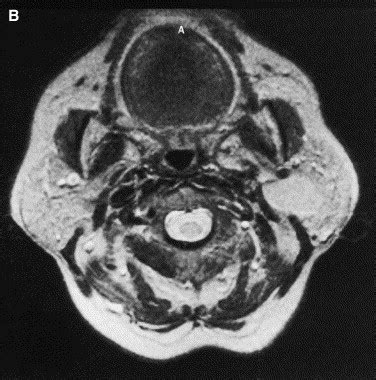 MR Imaging Findings Of Parotid Tumors With Pathologic Diagnostic Clues