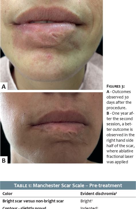 Table 1 From Laser Versus Microneedling For The Treatment Of Facial