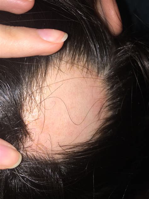 Do You Guys See Any Signs Of Regrowth R Alopecia Areata