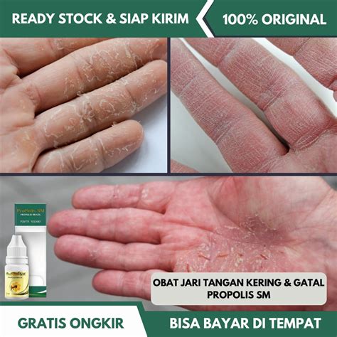 Jual Obat Jari Tangan Kering Obat Telapak Tangan Kasar Obat Tangan