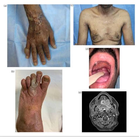 Pdf Locally Advanced Tongue Squamous Cell Carcinoma In Epidermolysis