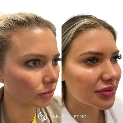 Chin And Jawline Filler In Dallas TX OMNI SCULPT MD