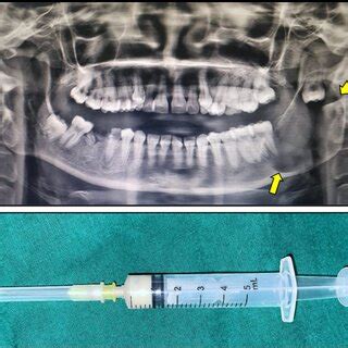 A Orthopantomogram Showing A Well Defined Unilocular Radiolucent