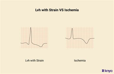 LVH with Strain and Ischemia, Know about Electrocardiographic Pattern ...