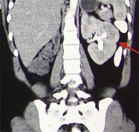 Coronal section of CT scan revealed normal structure of left kidney and... | Download Scientific ...