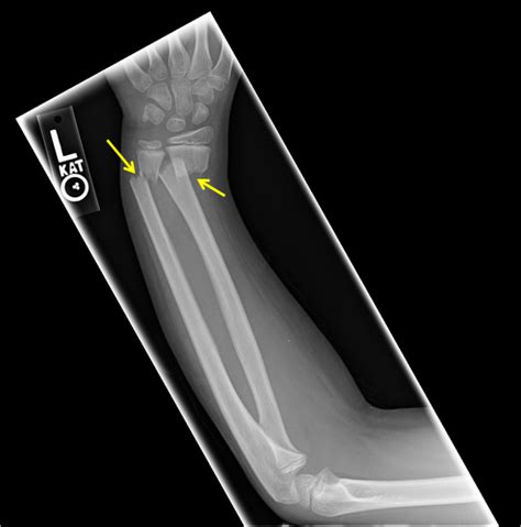 Both Bone Forearm Fracture Radiologypicscom