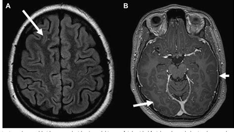 Figure 2 From Anti Nmda Receptor Encephalitis Semantic Scholar