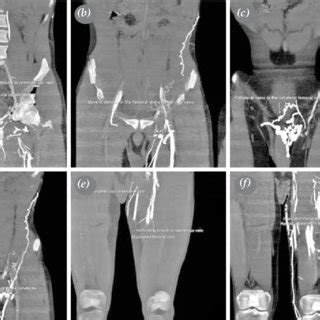 Control computed tomographic venography of a patient three months after... | Download Scientific ...