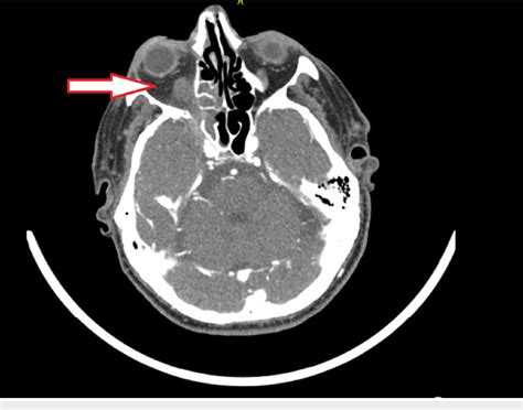 Figure 1 From Cavernous Sinus Thrombosis Due To Chronic Bacterial Sinusitis Semantic Scholar